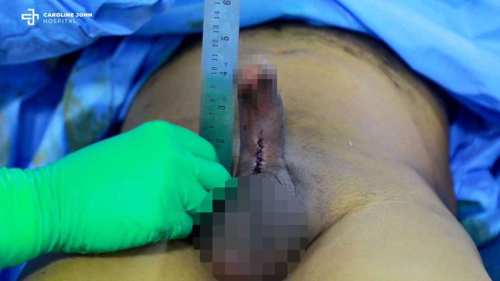 PENILE IMPLANT
