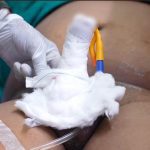 Penile Implant Cost in India