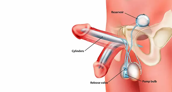 Penile Implant Side Effects: Risks, Benefits, and What to Expect
