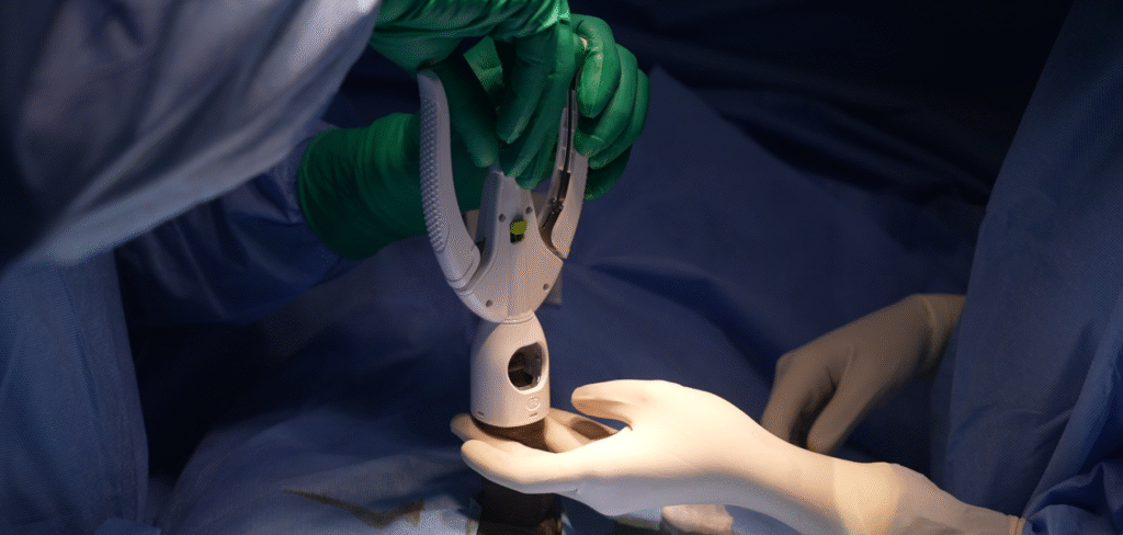 ZSR Stapler circumcision – A new and advance method