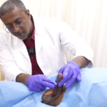 When Pills Fail: A Real-Life Story of Choosing a Promedon Malleable Implant for Vascular ED